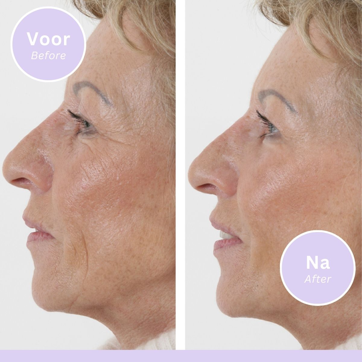 Wrinkle Filler - Siero Antirughe - 15 Ml - Confezione da 3